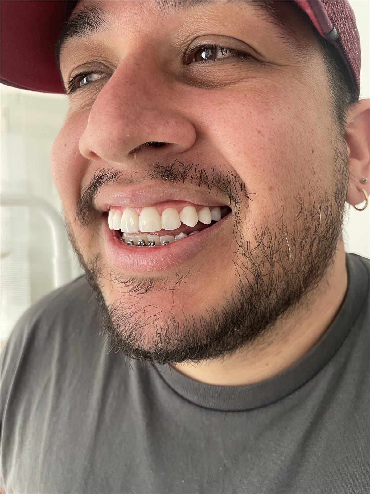 Patient 1 after porcelain smile design final smile