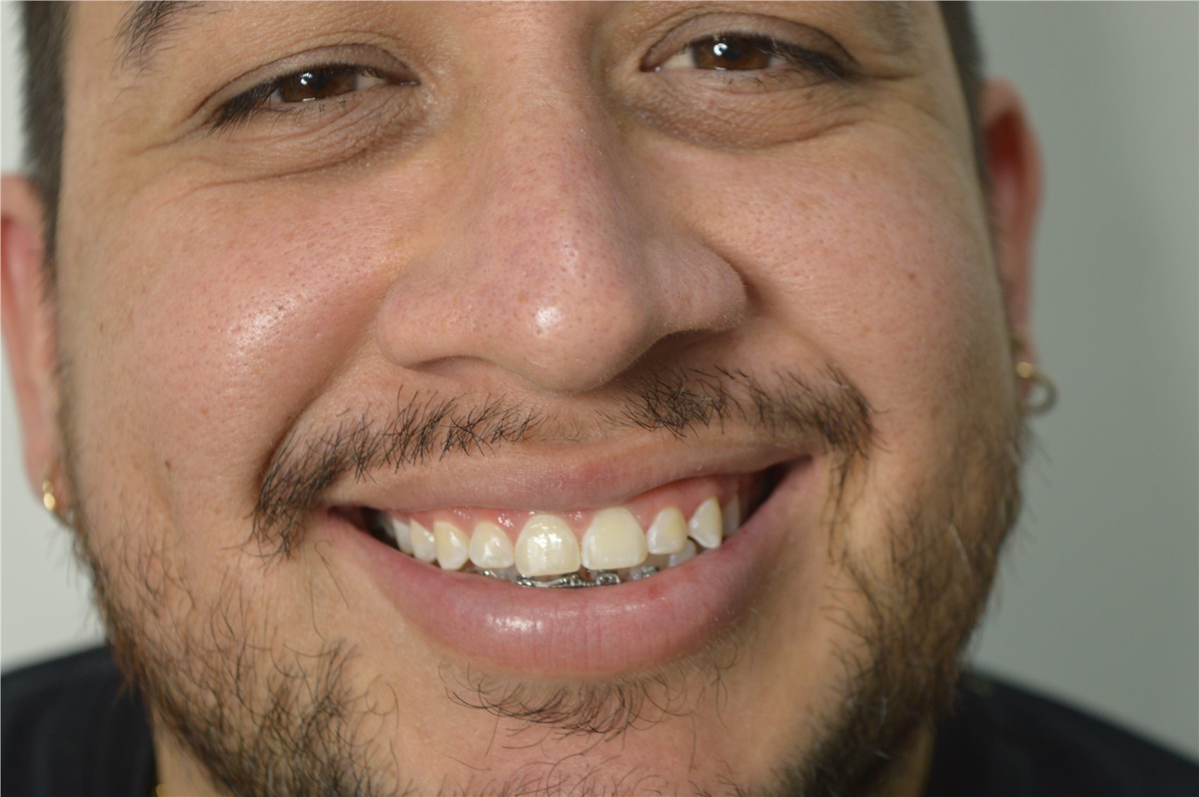 Patient 1 before porcelain smile design detailed smile