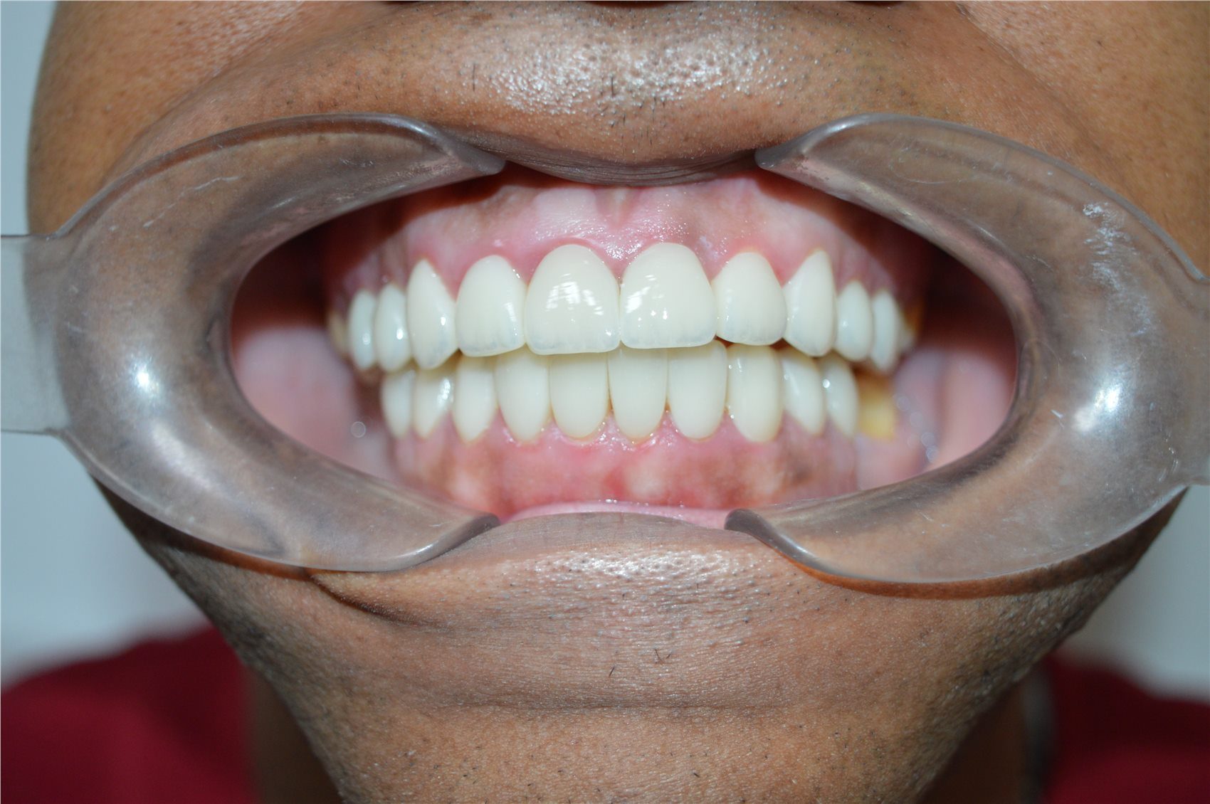 Patient 2 after porcelain smile design frontal clinical view