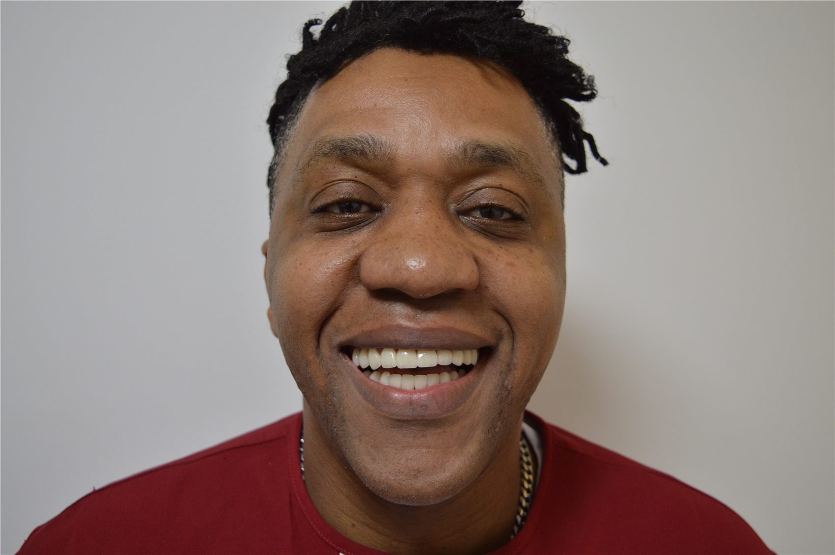 Patient 2 after porcelain smile design smiling portrait
