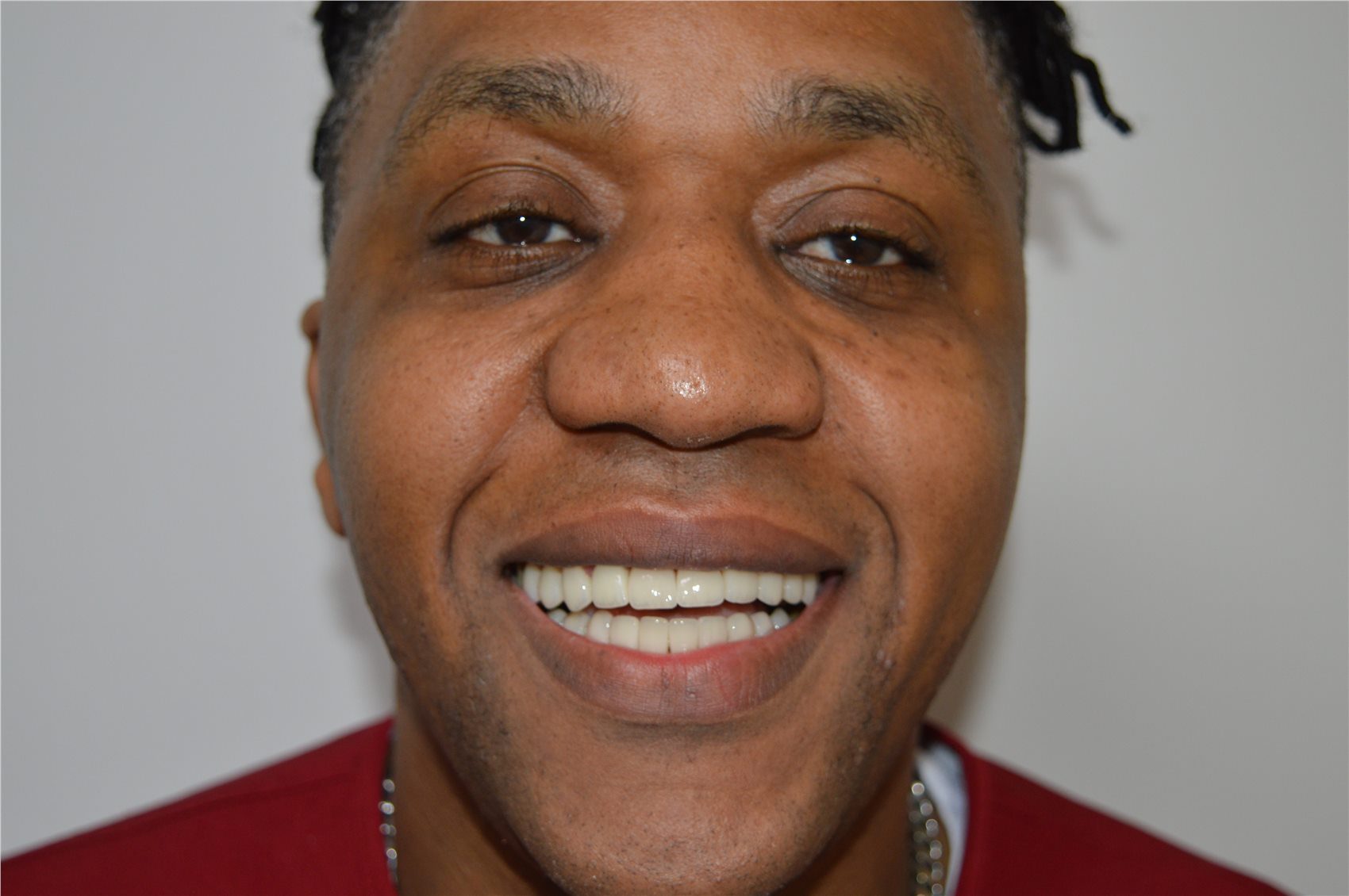 Patient 2 after porcelain smile design close smiling portrait