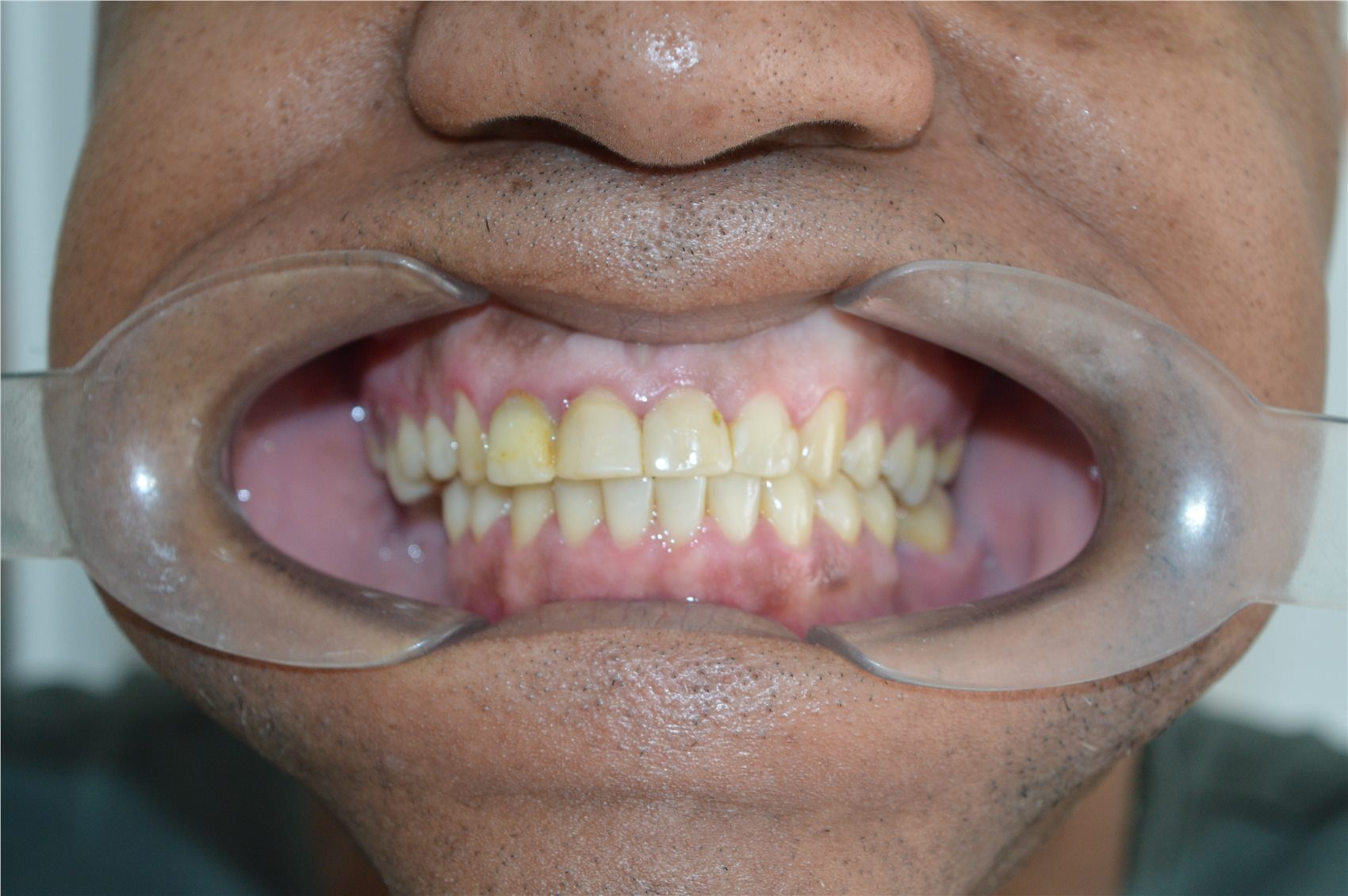 Patient 2 before porcelain smile design retracted front view