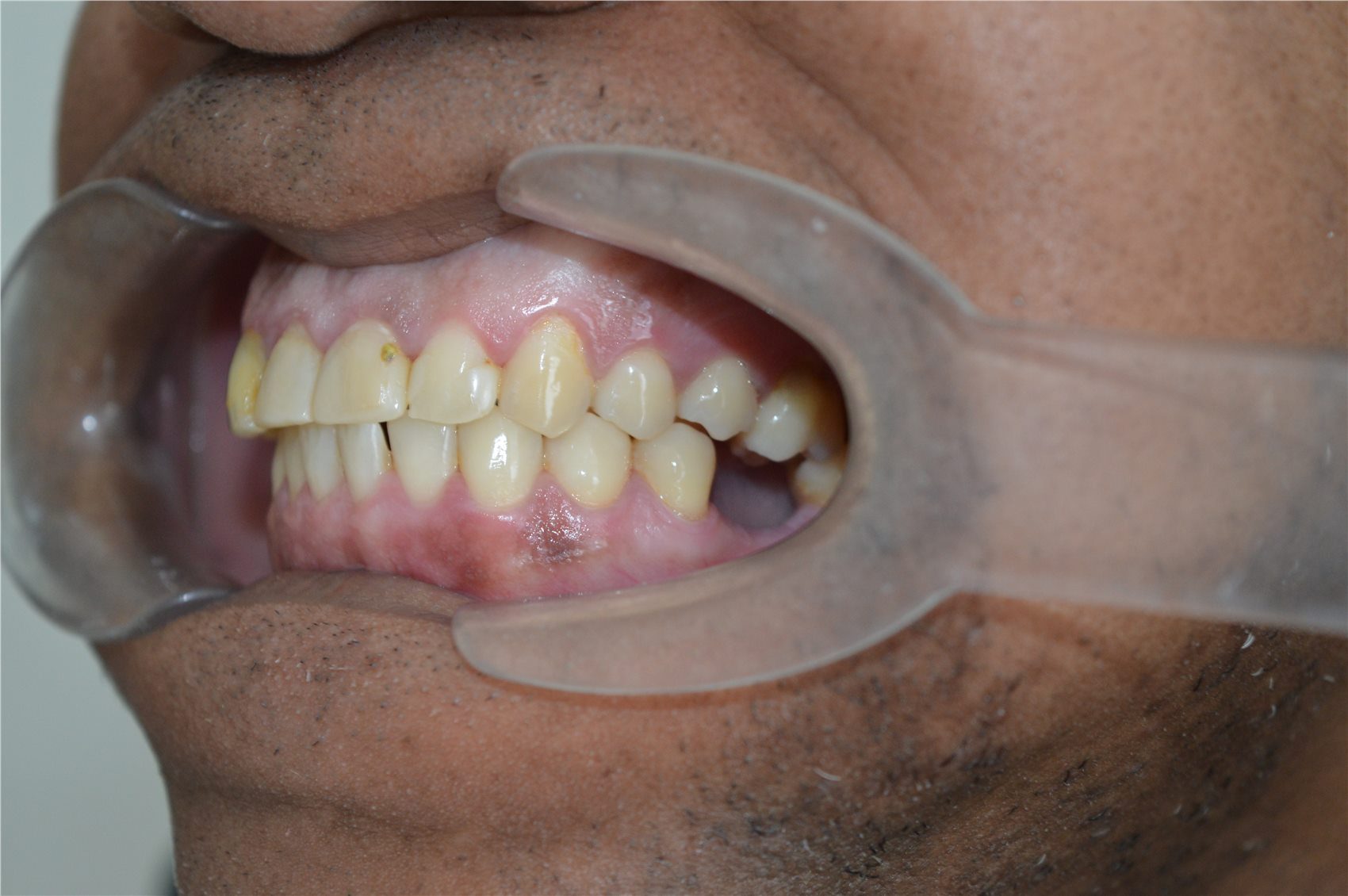 Patient 2 before porcelain smile design retracted side view