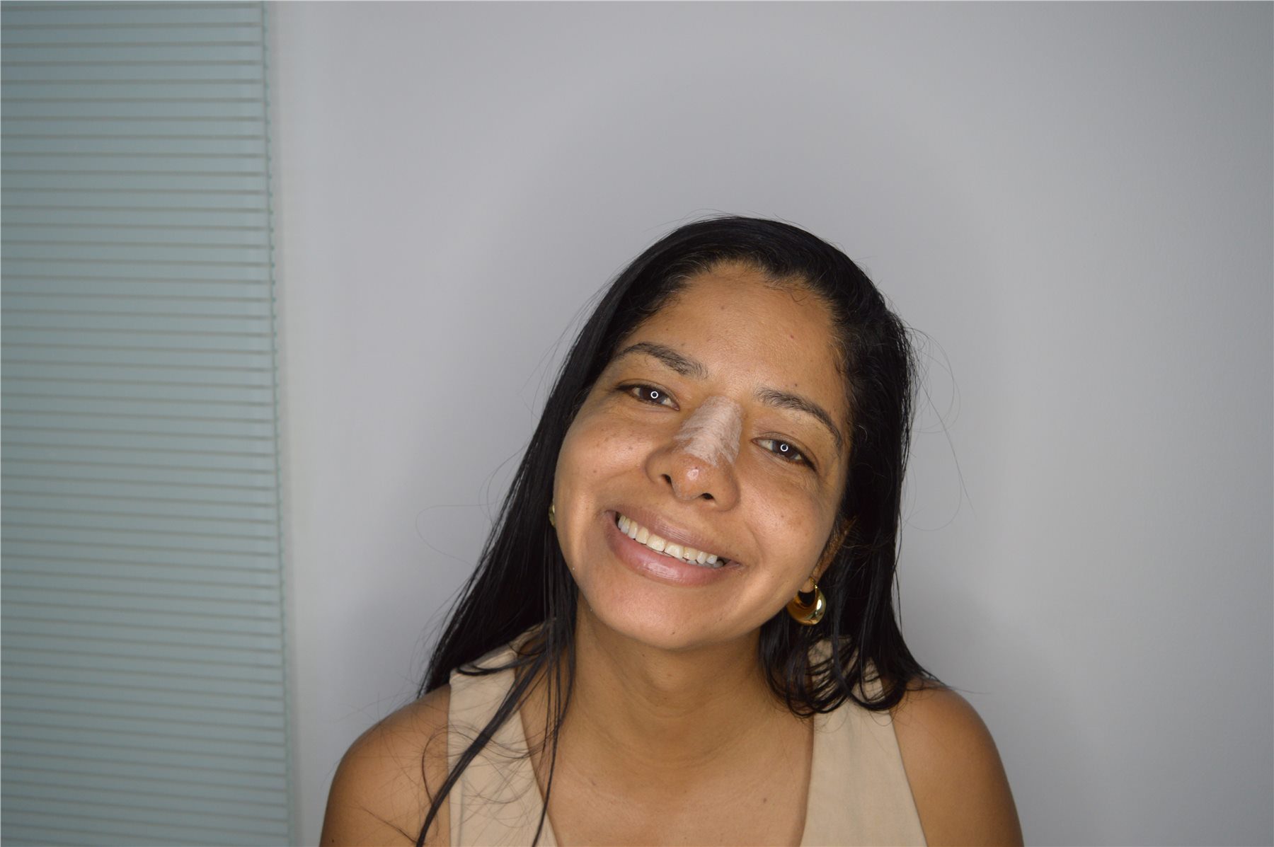 Smile design before treatment first view