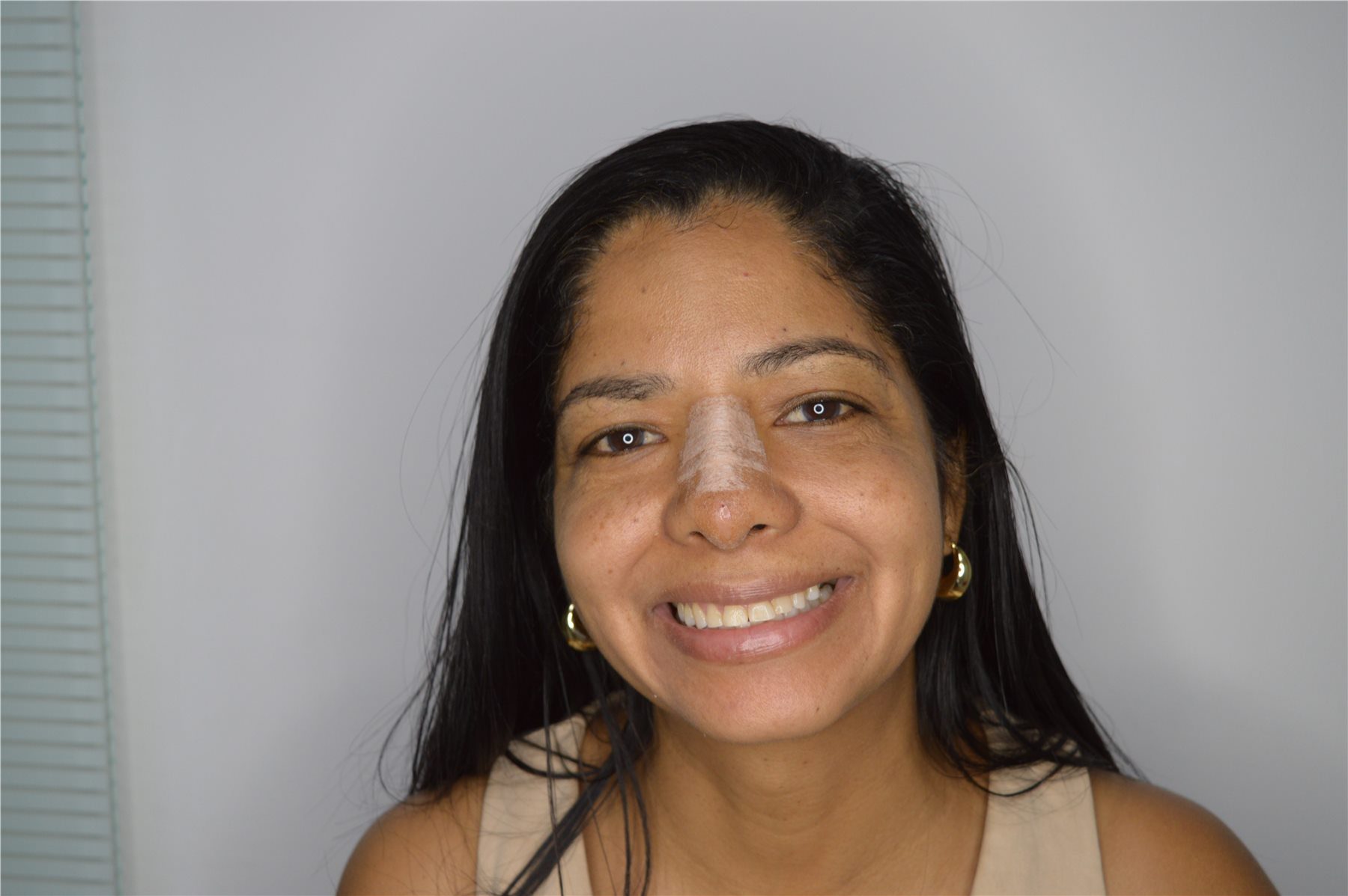 Smile design before treatment close view